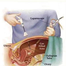 Laparasopic Hysterectomy